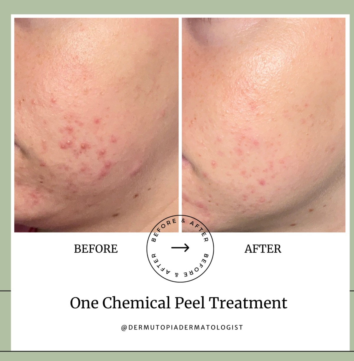 Chemical Peels for Acne